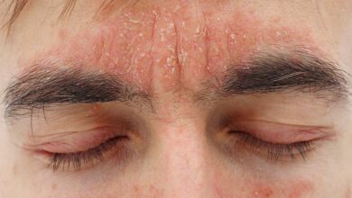 Skin & eye dryness